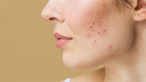 7 Tips To Effectively Deal With Acne-prone Sensitive Skin | Lifestyle ...