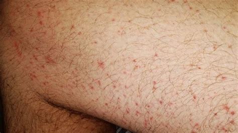 Coronavirus shows up in the skin - ABC Radio National