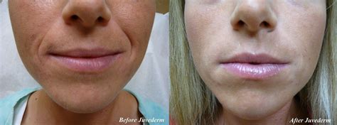 Nasal Fold Filler Before And After