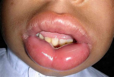 Swollen Lips And Hives Pictures | Lipstutorial.org