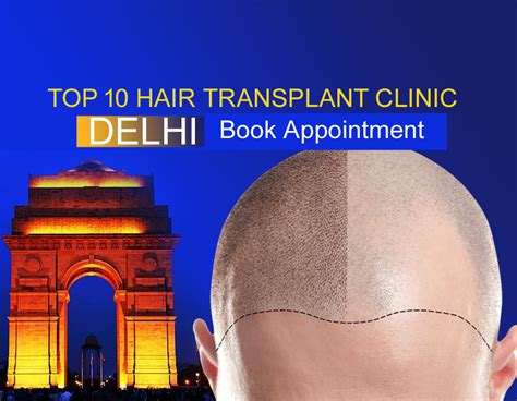 Top 16 Best Hair Transplant Clinics in Delhi 2024