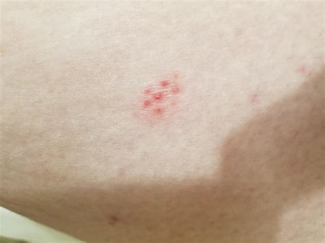 I get these clusters of sorta itchy bumps in random places sometimes ...