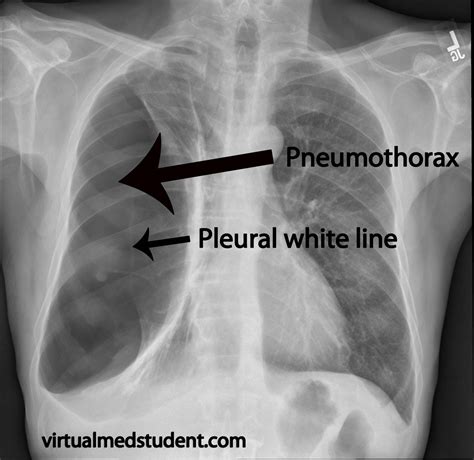 NADI IMAN MEDICAL 0351919657: KIND OF ABNORMALITIES CHEST X-RAY