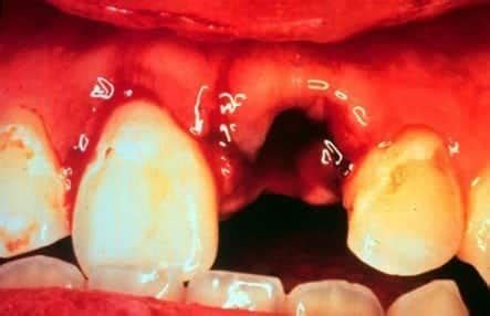 Tooth Avulsion • LITFL • Trauma Library