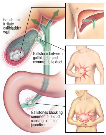 Gallstone removal surgery in Kalyan | Gallstone surgery in Kalyan