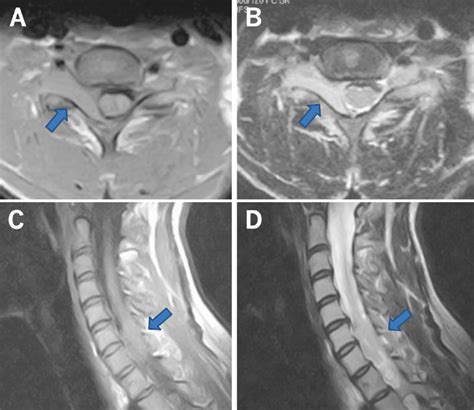 T1-and T2-weighted axial MRI of the cervical spine showed an Eden type ...