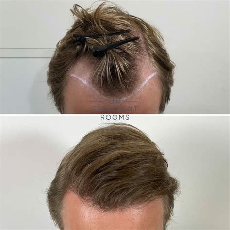 Receding Hairline & Hairline Transplant | Treatment Rooms London