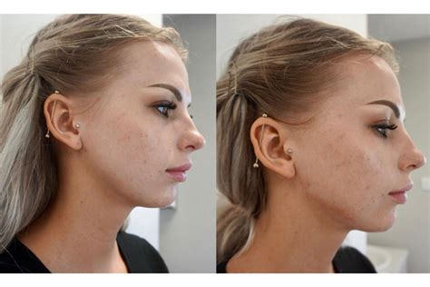 Jawline Contouring Dublin - Jawline Filler - Facial Rejuve