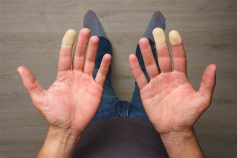 Raynaud’s Syndrome – Symptoms and Treatment Options - WWMG Blog