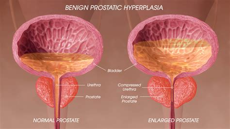 Prostate Enlargement - Expert IR- Neuro And Vascular Clinic