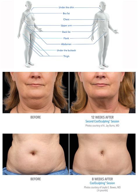 Fat Freezing Procedure Before And After