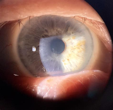 Vortex keratopathy : r/optometry