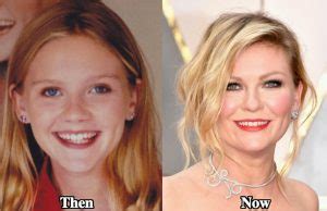 Kirsten Dunst Teeth before and after - Latest Plastic Surgery Gossip ...