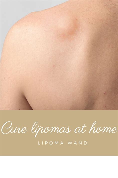 Pin on Lipoma Removals