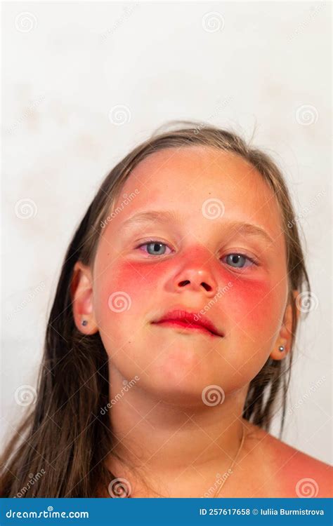 Portrait Closeup of Little Girl with Severe Red Burns on Nose and Cheeks after Spending Time in ...