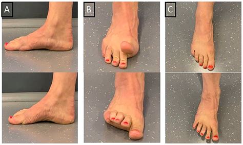 Using Shockwave, Foot Core Exercises to Manage Tibialis Posterior ...