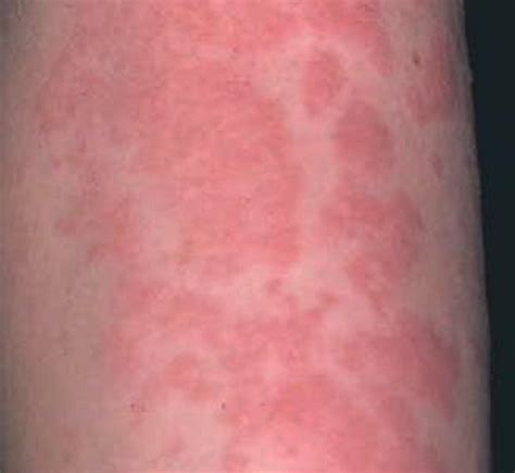 Stress Rash - Pictures, Symptoms, Causes, Treatment