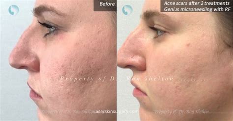 Acne Scar Treatments NYC | Scar Reduction by Dr Ron Shelton