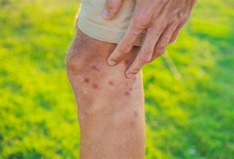 How to Prevent and Treat Sand Flea Bites? | A Complete Guide - EXOtella