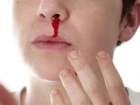 Epistaxis - Definition of Epistaxis