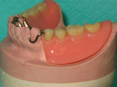 Clasps for dentures: classification, types, manufacturing