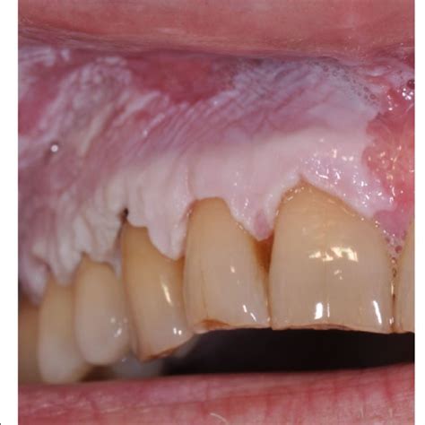 Severe verrucous hyperkeratosis with elongation of dermic ridges and... | Download Scientific ...