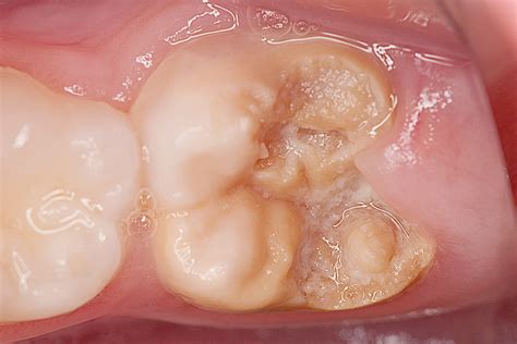 What Causes Chalky Teeth (Molar-Incisor Hypomineralisation)?