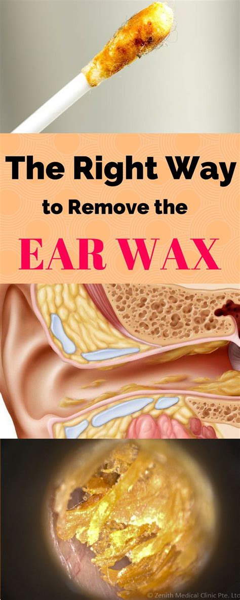 jun | Ear wax, Ear cleaning wax, Healthy tips