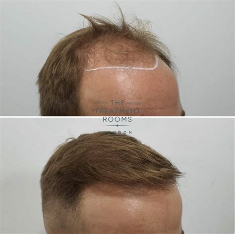 Norwood 4 Hair Transplant | The Treatment Rooms London