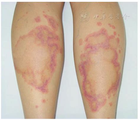 Urticarial Vasculitis of the Legs | International Journal of Dermatology and Venereology