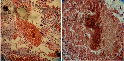 Nocardiosis: Clinical and Pathological Aspects | IntechOpen