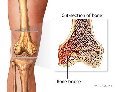 Shin Bone Bruise