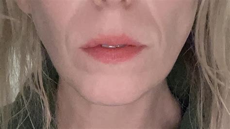 Crooked jaw after surgery - what do I do?! : r/jawsurgery