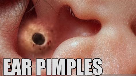 Ear Blackheads, Pimples in the Ear! - YouTube