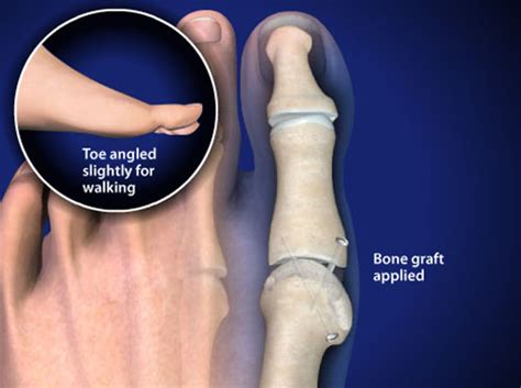 Video - Big Toe Fusion (First Metatarsal-Phalangeal Joint Arthrodesis ...