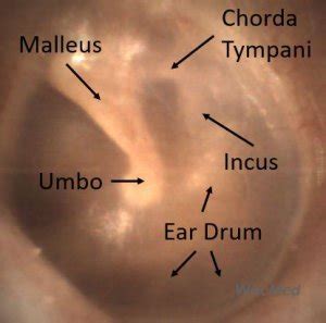 Normal Ear Drum Anatomy - WiscMed