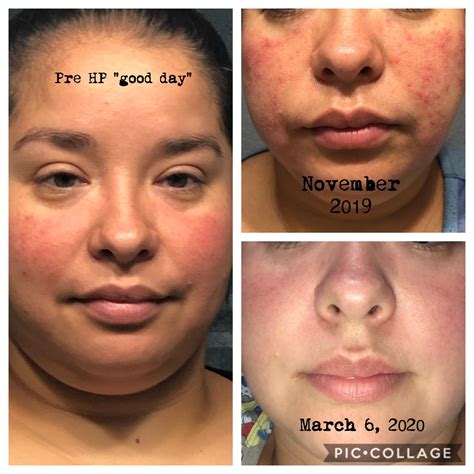 Before & After Photos- My Rosacea Journey : r/Rosacea