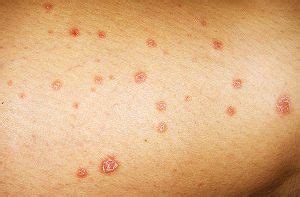 Home Remedies for Guttate Psoriasis | Wellnessbin