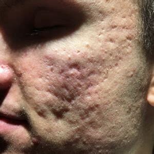 Moderate Acne Scars
