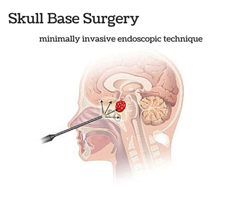 Skull Base Surgery