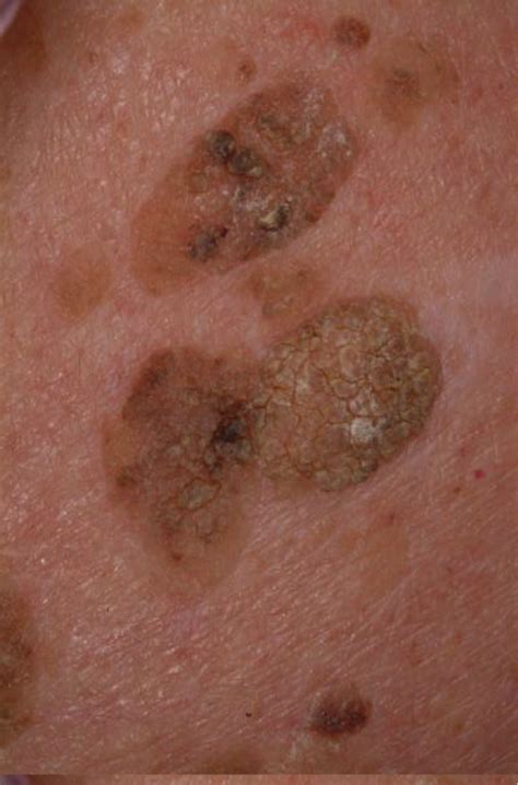 types of keratosis - pictures, photos