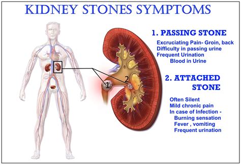 Medicine Health And You: Kidney Stone Symptoms