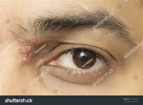 Herpes Zoster Ophthalmicus Eye Herpetic Cold Stock Photo 157796294 | Shutterstock