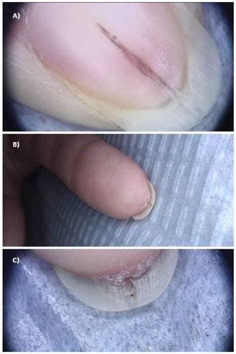 JCM | Free Full-Text | Sonographic Features of Onychopapilloma: A ...