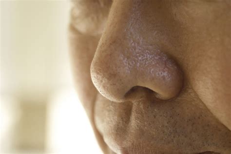 Loss of smell, taste symptoms can help identify patients - The Shillong ...