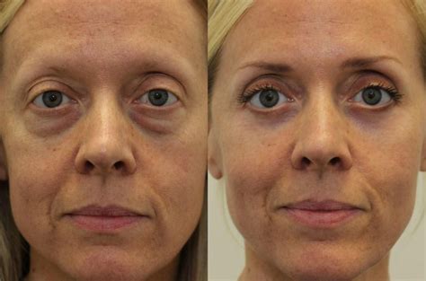 Cosmetic Surgery Eye Bag Removal Before And After - ferien zum ausdrucken