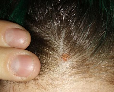 How To Treat Scabs On The Scalp – BOS-BBQ