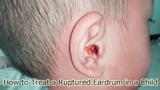How to Treat a Ruptured Eardrum in a Child