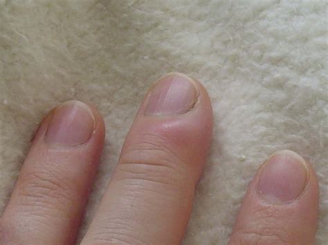 Treatment of fingernail fungus | General center | SteadyHealth.com