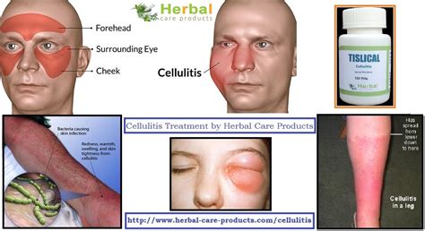 Cellulitis Face Treatment - Doctor Heck